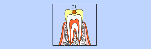 C1の虫歯