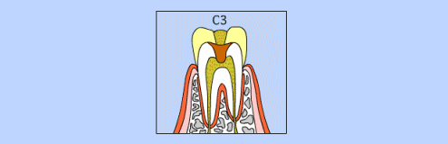 C3の虫歯