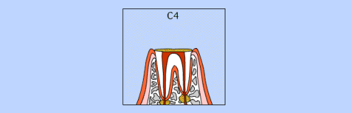 C4の虫歯