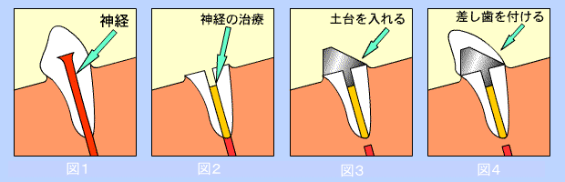 歯の被せ物治療